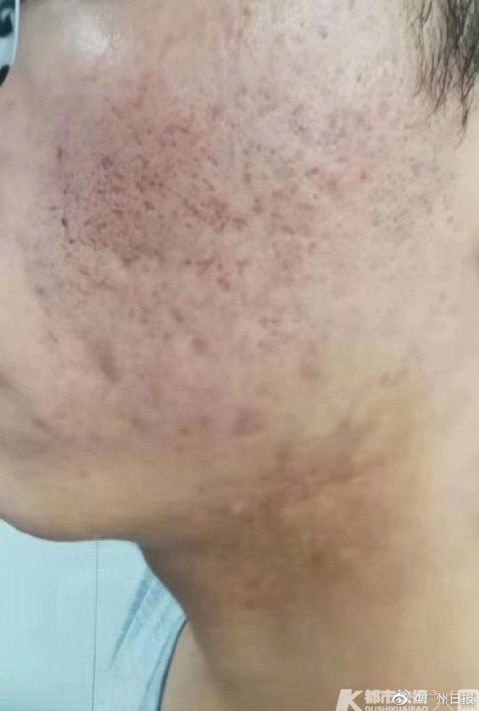 因为满脸青春痘 高三男生不得不休学!