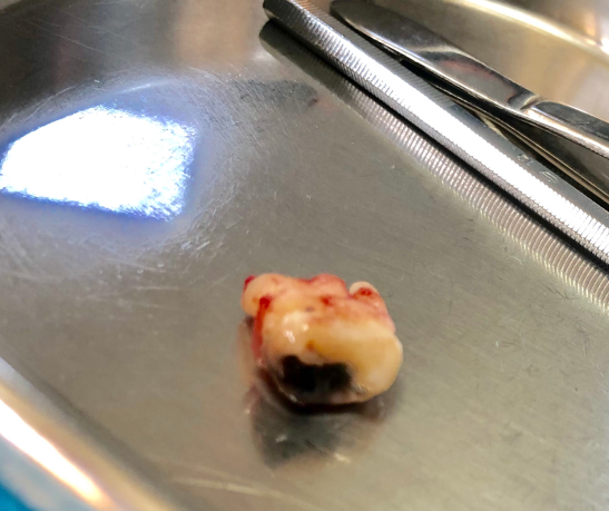 分享下去年拔四颗智齿的经历