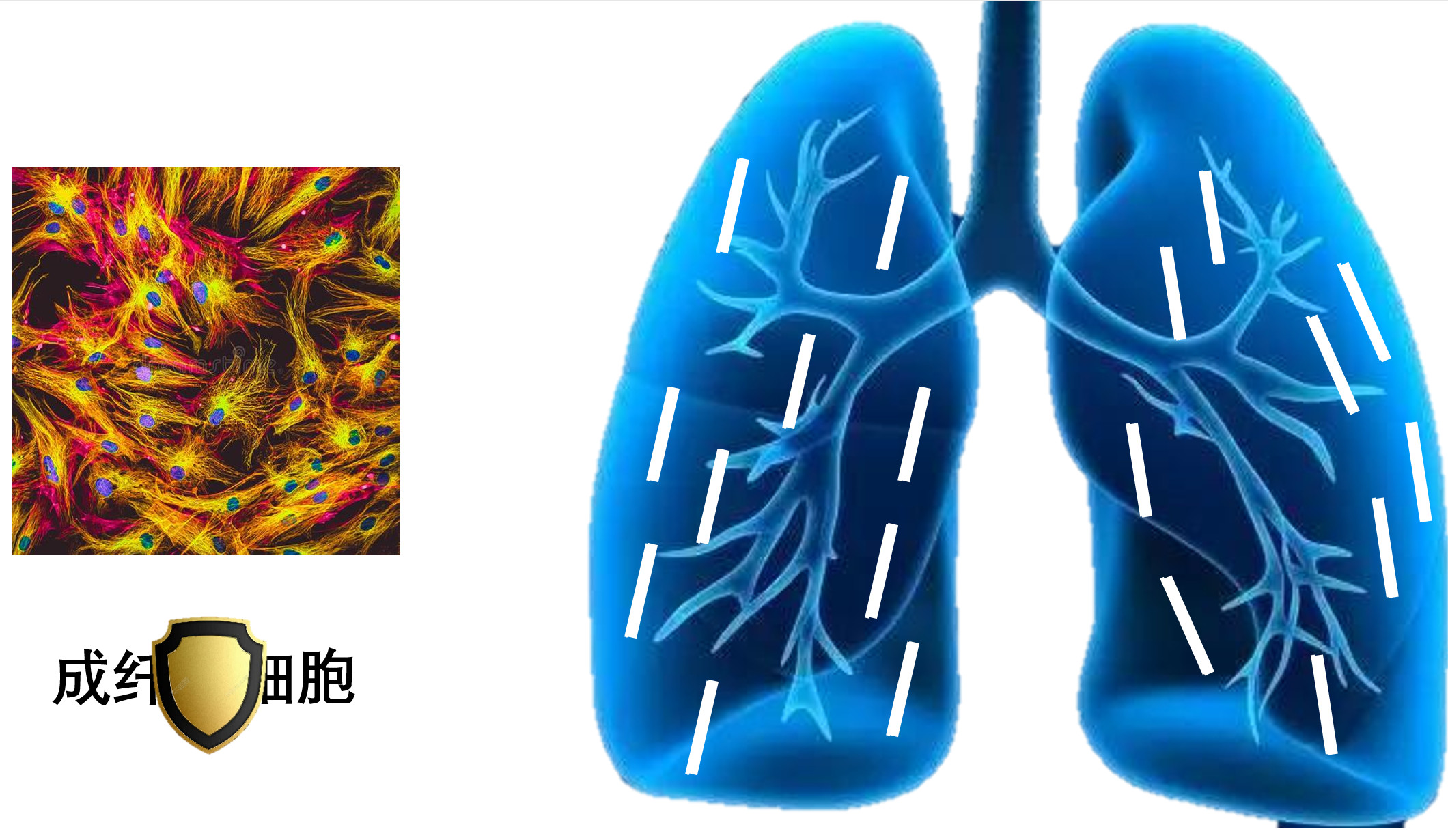 肺纤维化用药特种兵吡非尼酮尼达尼布