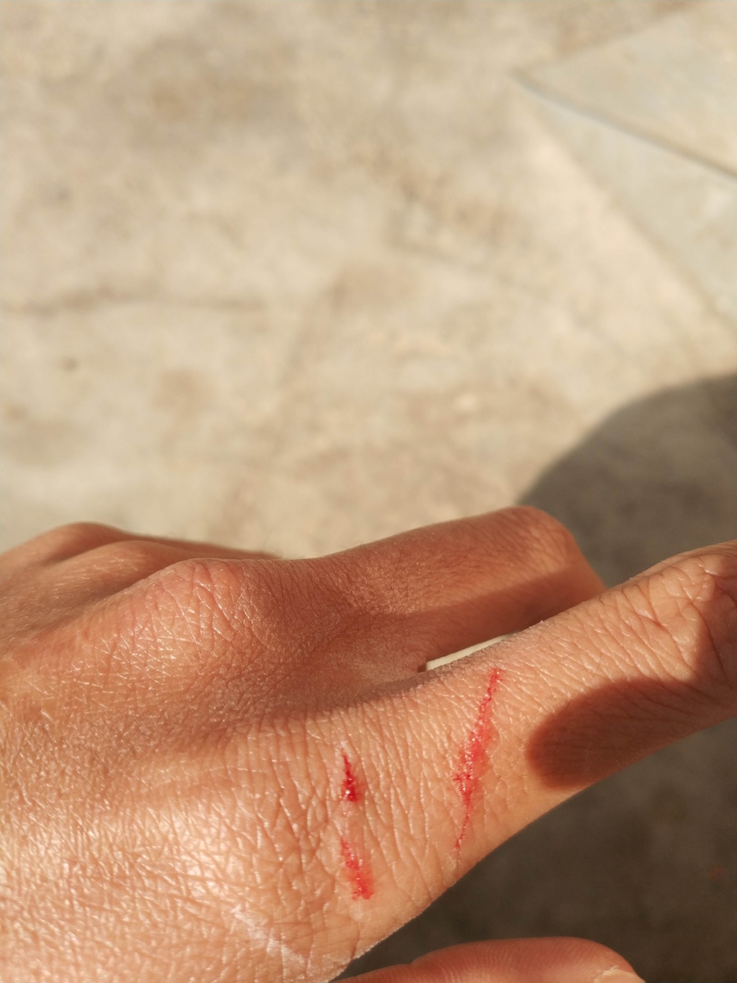 晚上偷偷跑出去恰烧烤被流浪猫抓伤