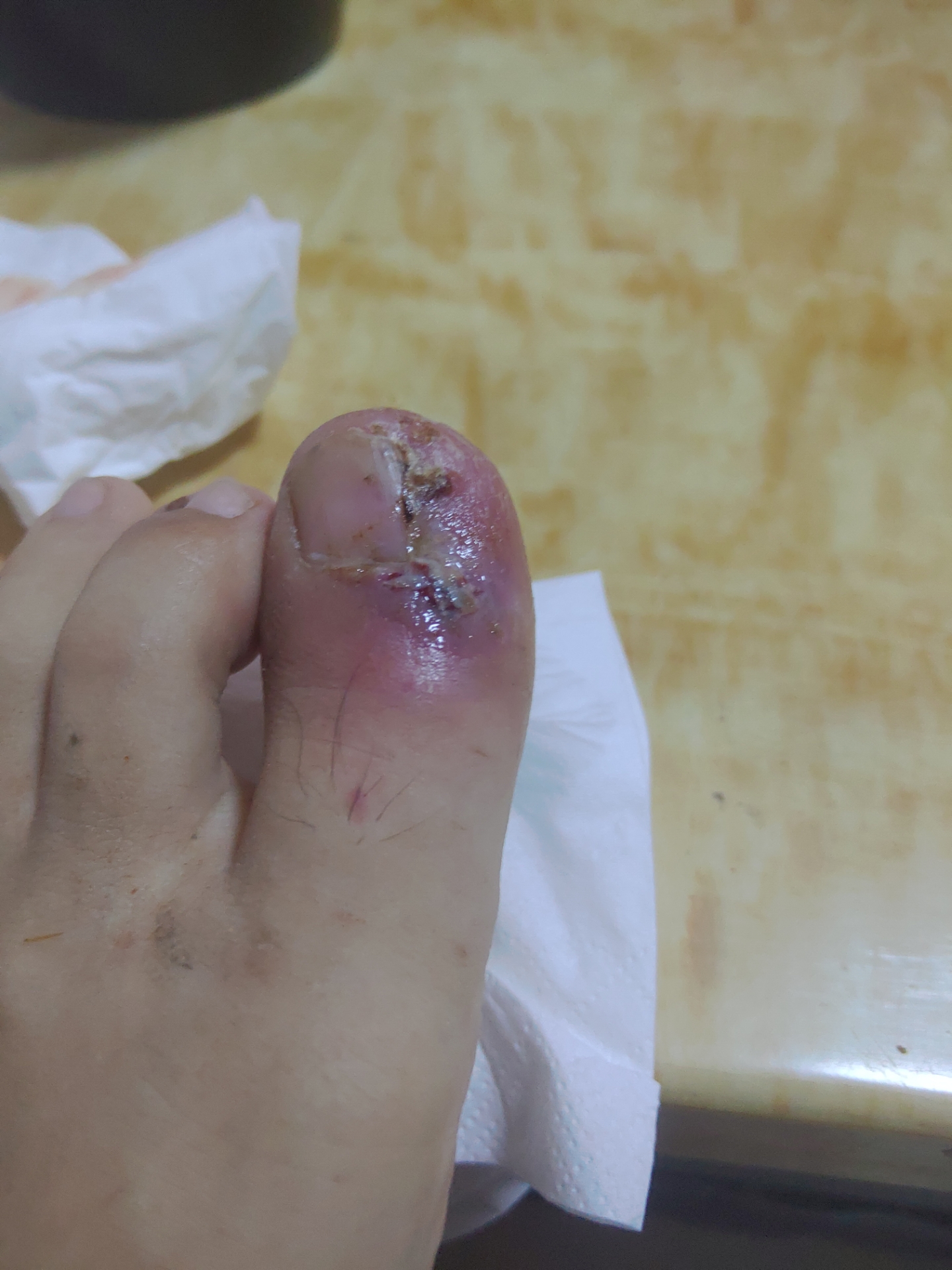 内容可能引起不适(甲沟炎手术)