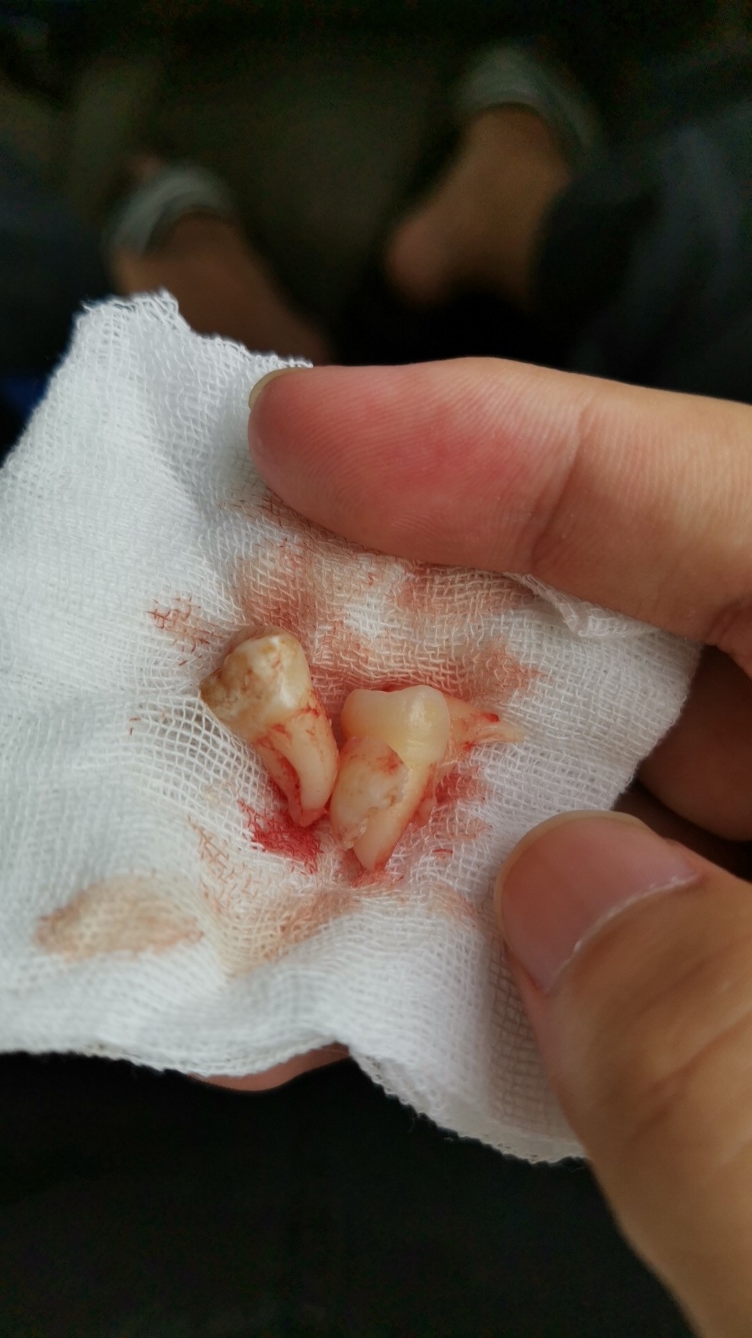 玛德拔个智齿嘴角撕裂了牙倒是不疼反而是嘴角结痂张不开嘴很疼有啥药