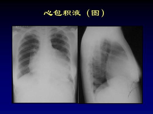 心包积液心电图图片