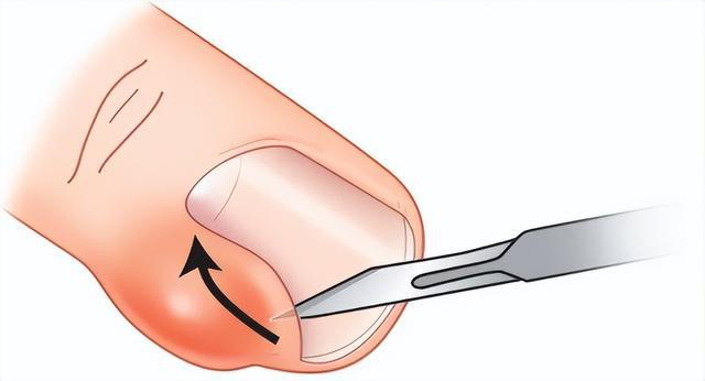 甲沟炎出现化脓了还能自己好起来吗?