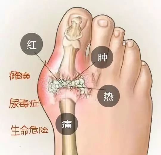 痛风的七个征兆图片图片