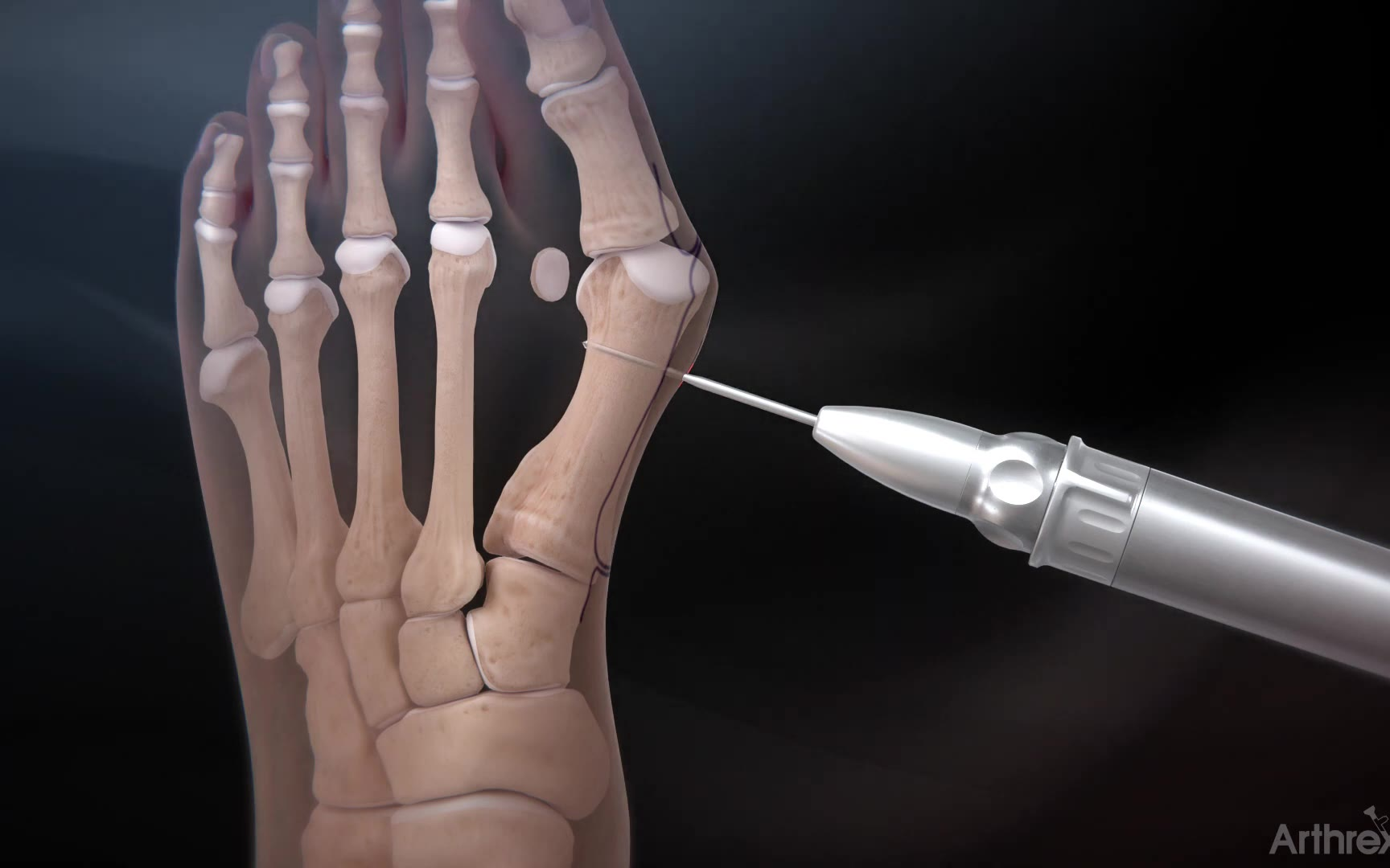 arthrex 微创拇囊炎切除系统手术技术