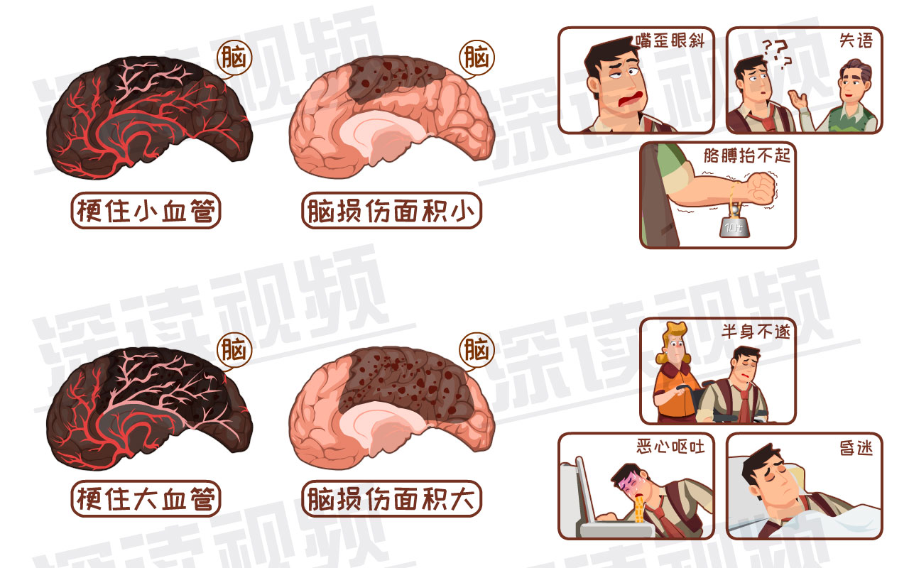 深读春节特别节目|通宵搓麻好嗨呦!突发脑梗风险高