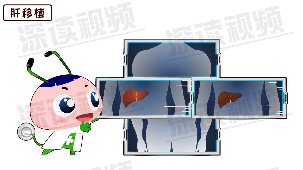 第四,肝移植 要是肝实在不给力,老是有腹水,还可以考虑肝移植,换个