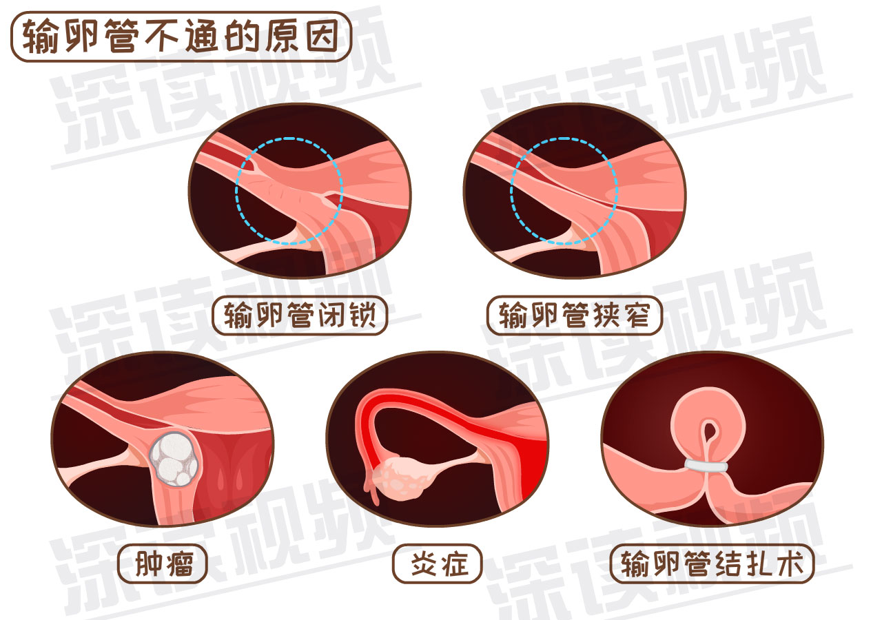 输卵管炎症会导致纤毛脱落和输卵管平滑肌