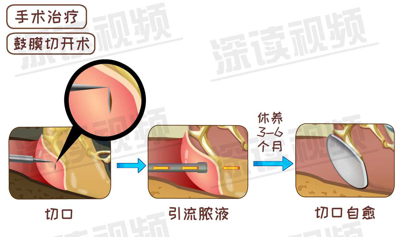 耳痛流脓该咋办?细数中耳炎治疗那些坑,良心知识科普贴!
